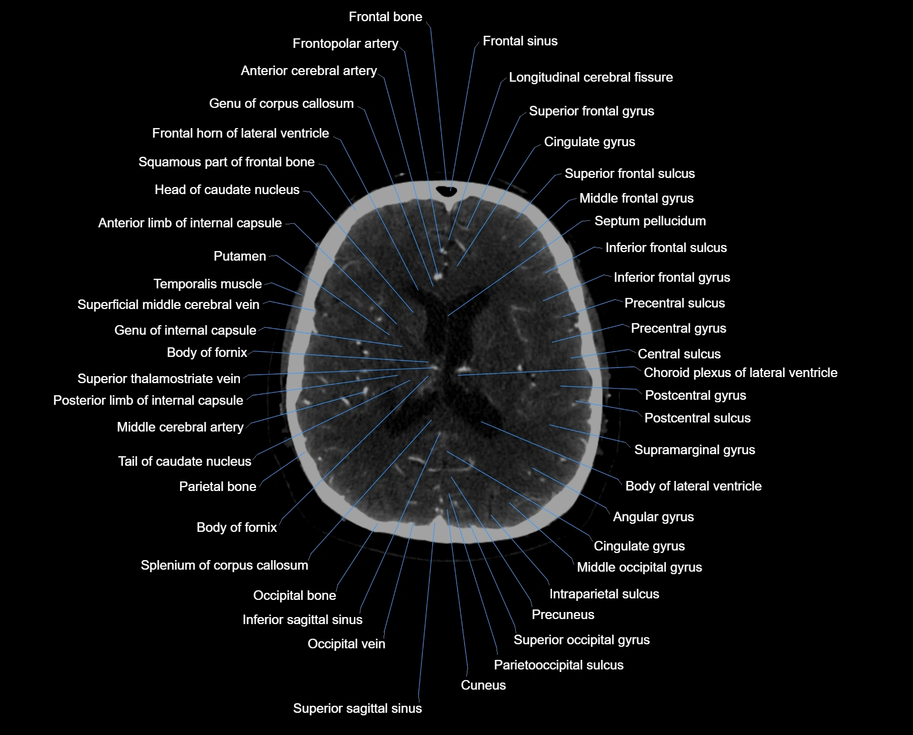 CT scan brain axial labelled cross sectional anatomy image-img-000042.webp